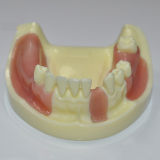 Dental absence of different teeth implant teeth model can exercise cut implant