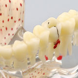 Dental osteoporosis and bad dental caries teeth study and demonstration model