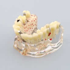 Dental osteoporosis and bad dental caries teeth study and demonstration model