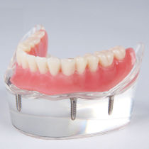 Details about  Dental implant restoration model with clear red gingival 4 pcs implants