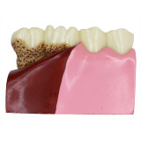 Dental Anatomy of dental caries plastic teeth model demonstration communication