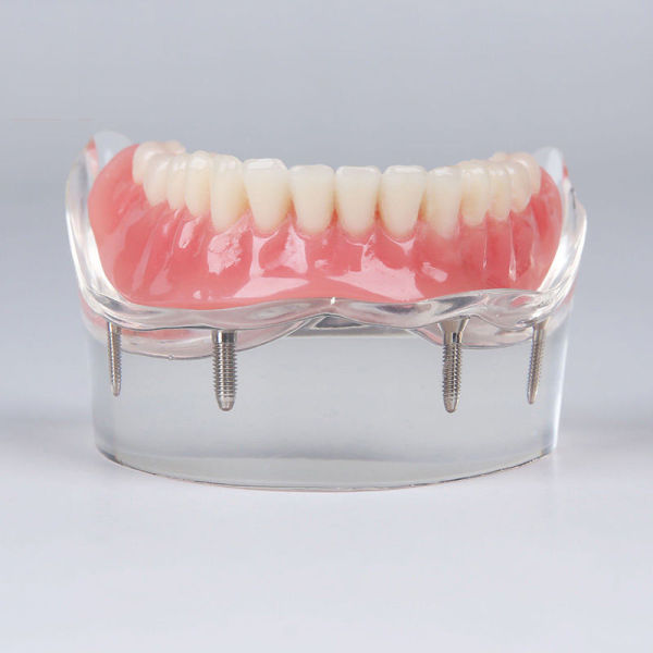 Details about  Dental implant restoration model with clear red gingival 4 pcs implants