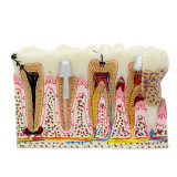 Dental Anatomy of dental caries plastic teeth model demonstration communication
