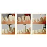 Dental Preparation Teeth Kit 8PCS For Porcelain Veneers FG0807D Clinic Dentist