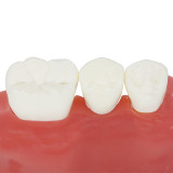 Dental Implant Analysis Crown Bridge Demonstration Teeth Model for Education