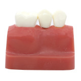 Dental Implant Analysis Crown Bridge Demonstration Teeth Model for Education